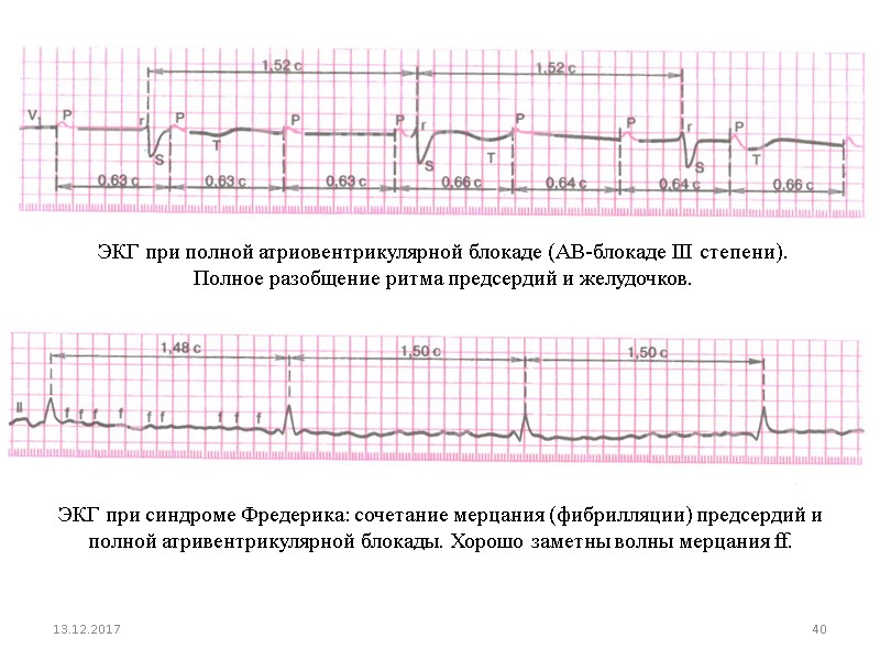 13.12.2017 40 ЭКГ при полной атриовентрикулярной блокаде (АВ-блокаде III степени).  Полное разобщение ритма